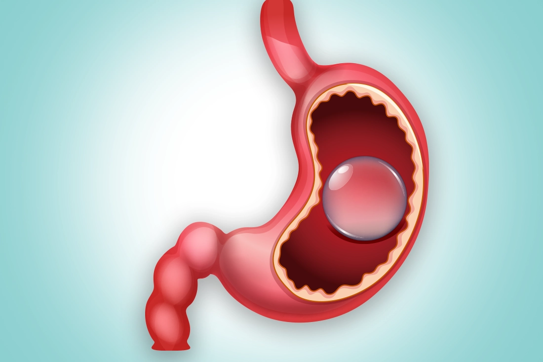 o9Medical - إجراء بالون المعدة في تركيا