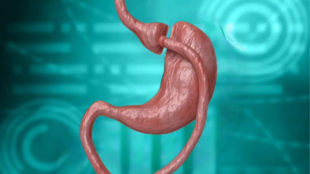 o9Medical - عملية تحويل مسار المعدة في تركيا